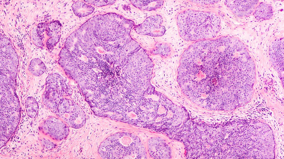 Rak dojke epidemiologija