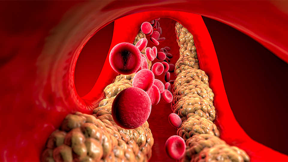 Zašto je lp(a) zapostavljen desetljećima?