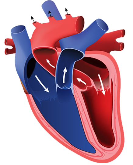 Ljevostrano desnostrano srce