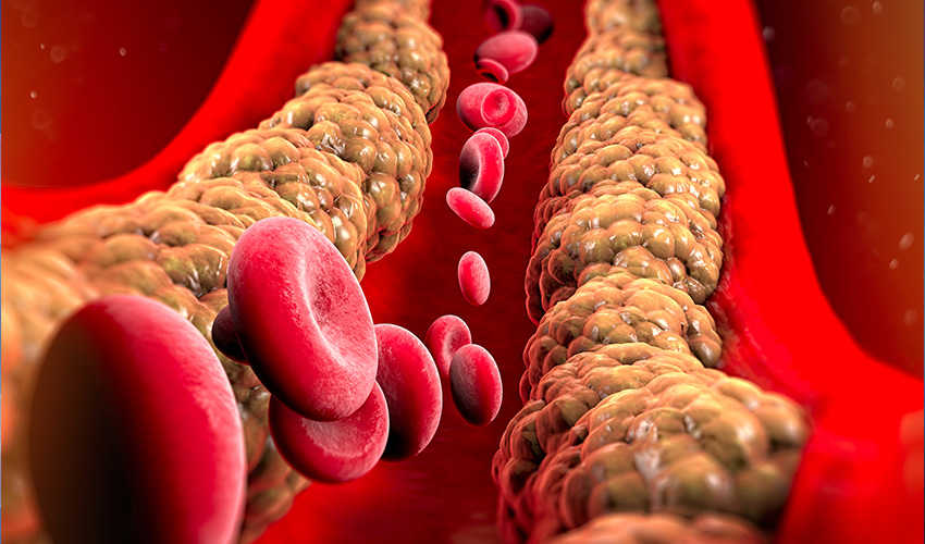 Povišene razine kolesterola - Što je LDL Povišene razine kolesterola - Što je LDL