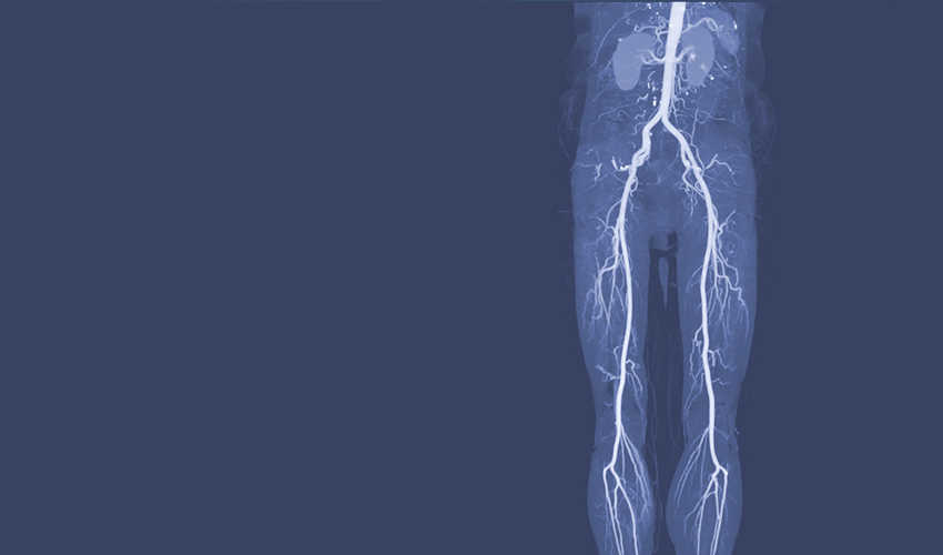 Bolest-perifernih-arterija---850-x-500-ver-2.jpg