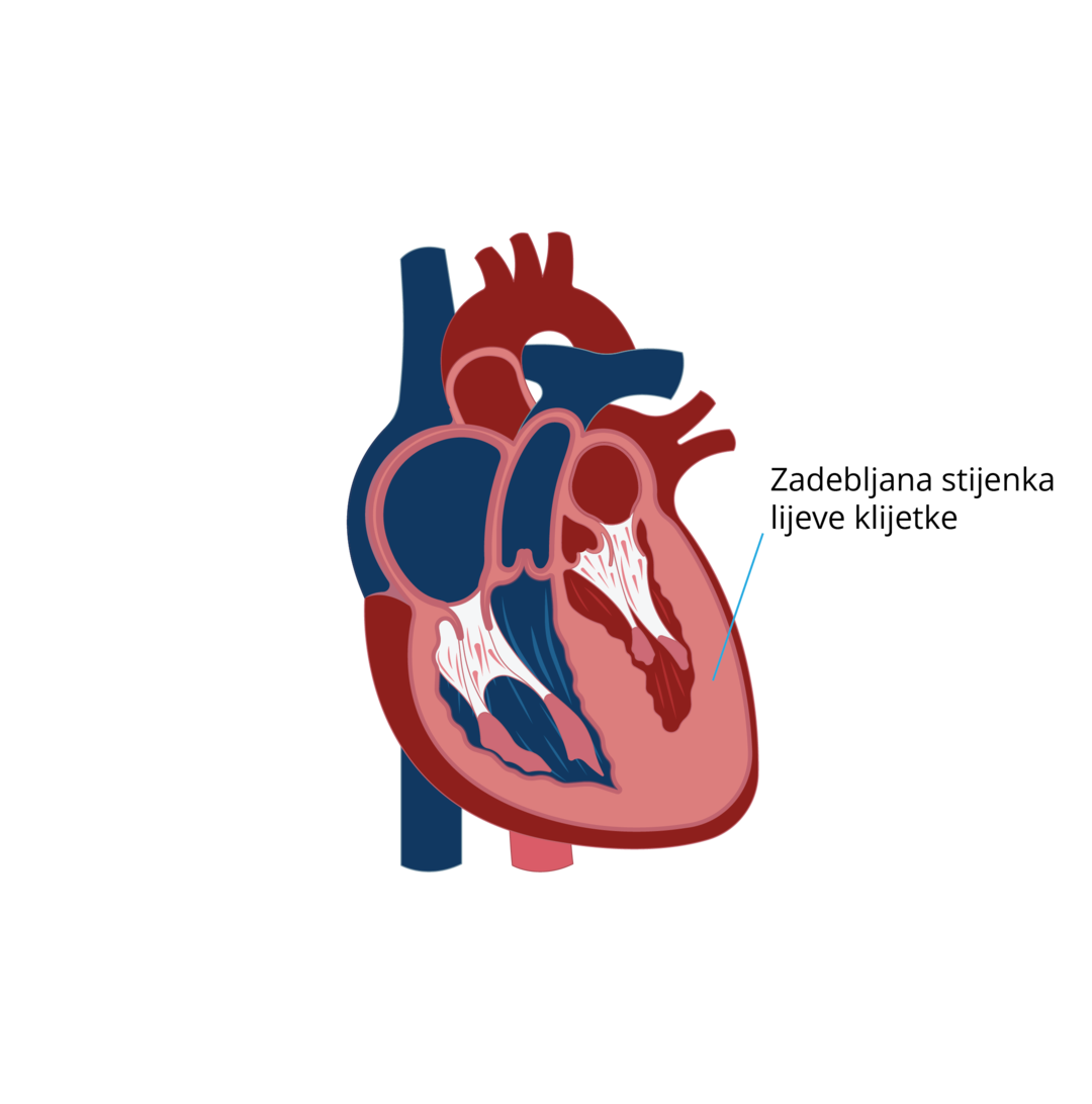 Oblici kardiomiopatija-07.png 