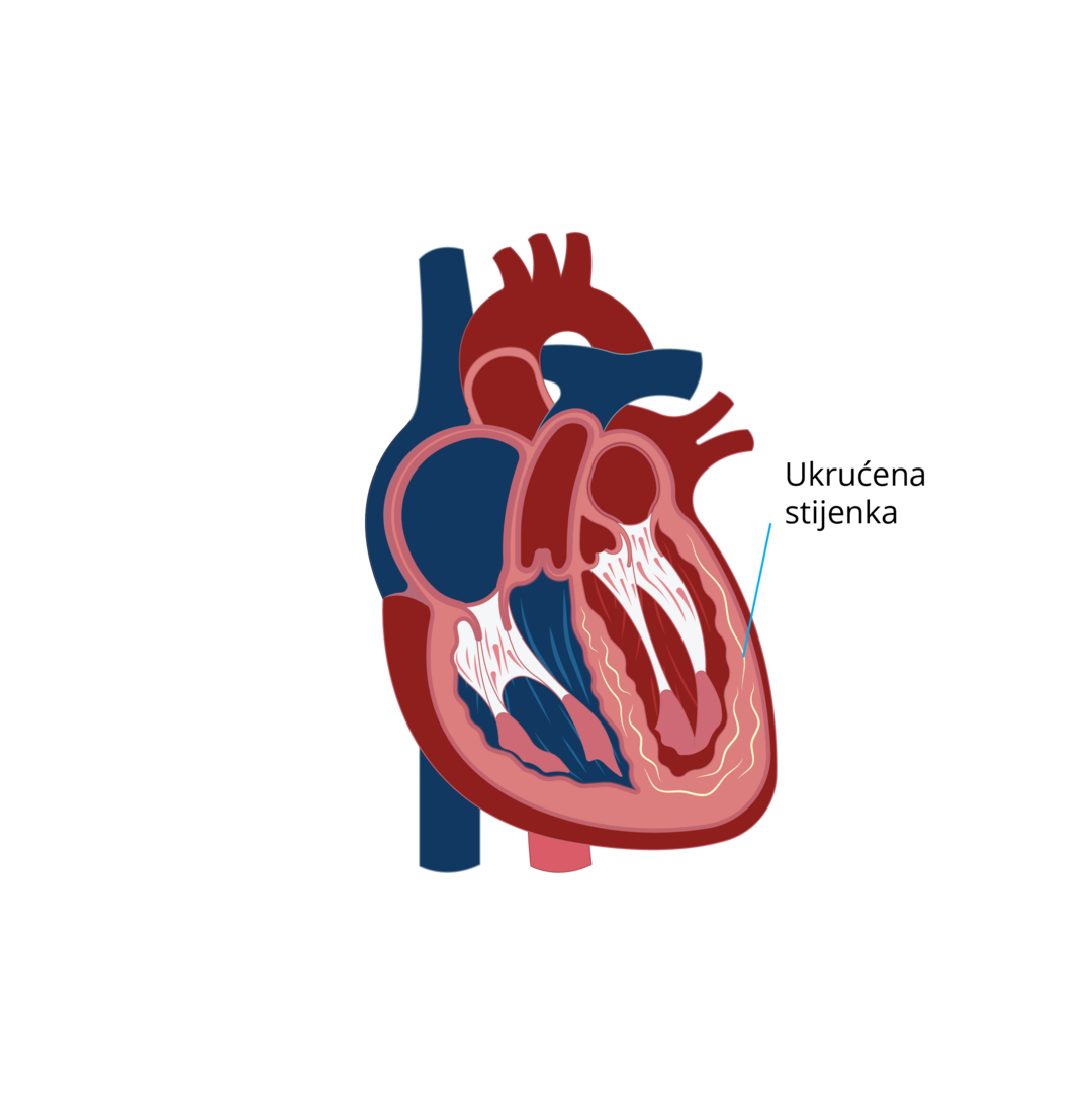 Oblici kardiomiopatija-08.png 