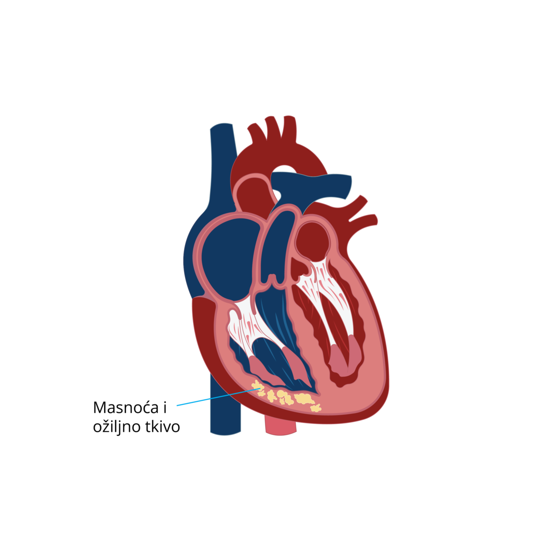 Oblici kardiomiopatija-09.png 