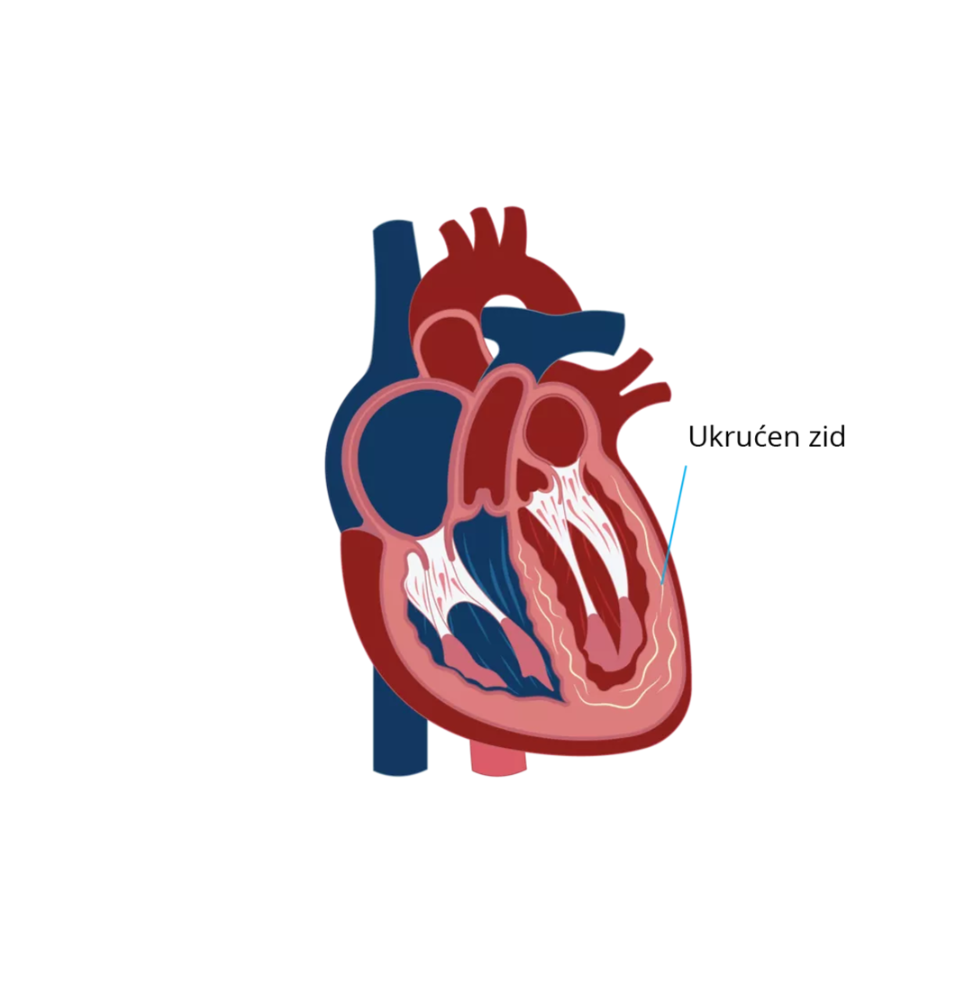 Restriktivna kardiomiopatija