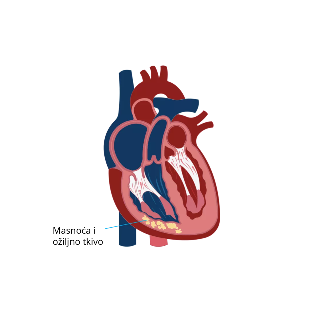Aritmogena displazija desne komore